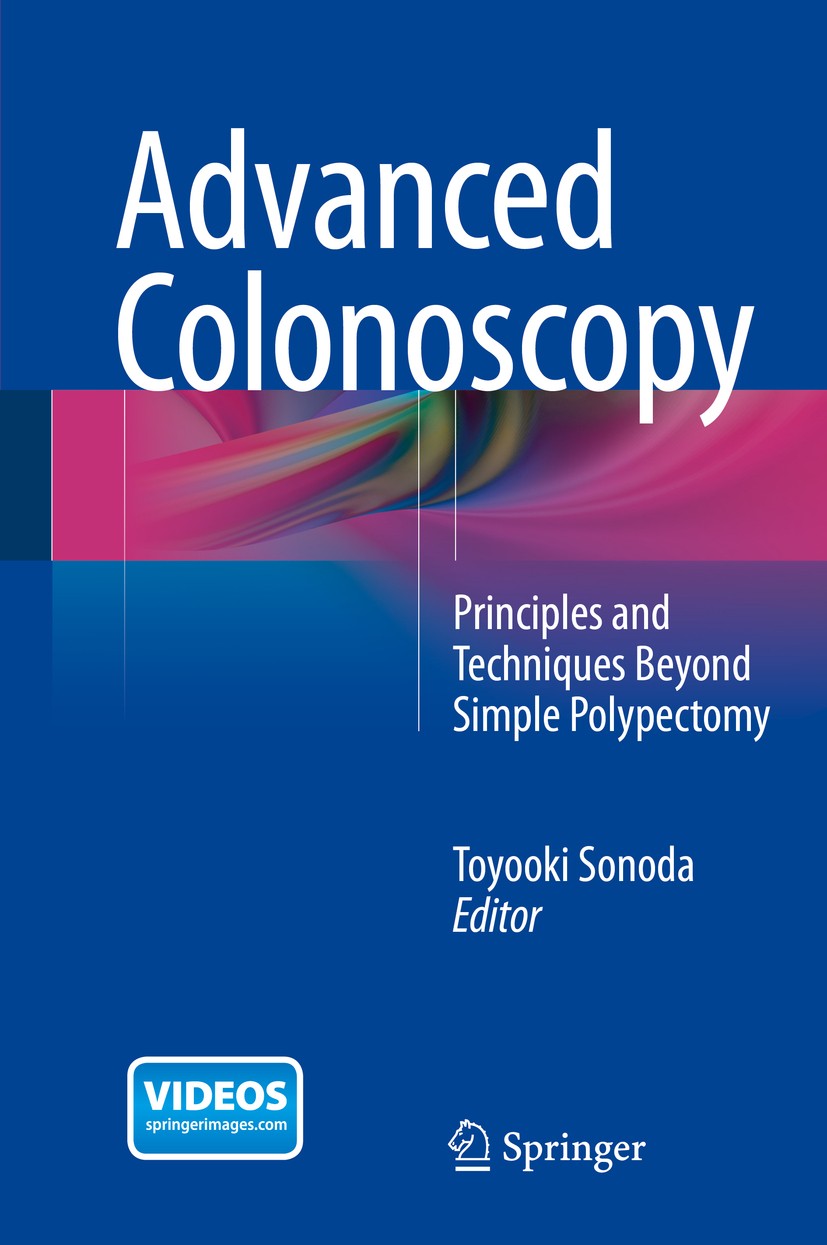 Titlebook: Advanced Colonoscopy; Principles and Techn Toyooki Sonoda Book 2014 Springer Science+Business Media New York 2014 colonic stenting.endolumi Titlebook: Advanced Colonoscopy; Principles and Techn Toyooki Sonoda Book 2014 Springer Science+Business Media New York 2014 colonic stenting.endolumi