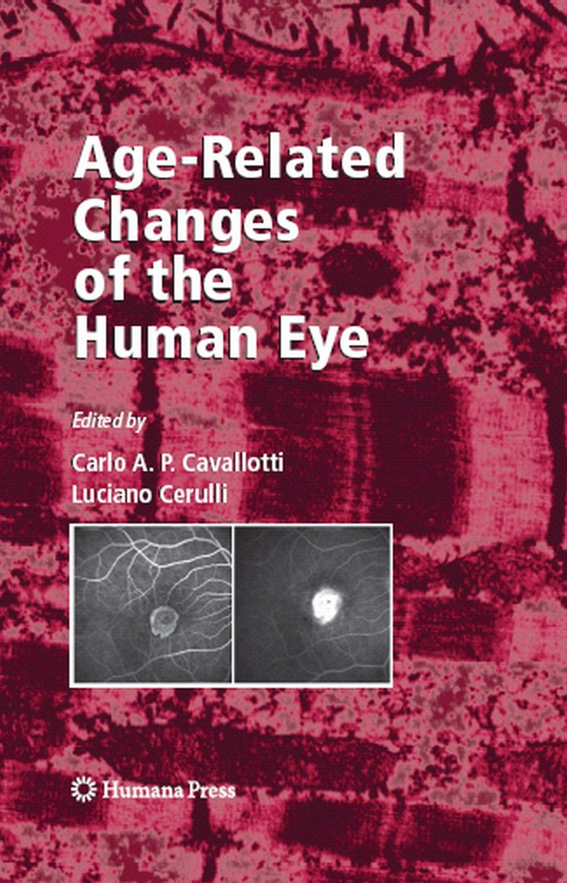 Titlebook: Age-Related Changes of the Human Eye; Carlo A. P. Cavallotti,Luciano Cerulli Book 2008 Humana Press 2008 Comprehensive.Scientific and clin Titlebook: Age-Related Changes of the Human Eye; Carlo A. P. Cavallotti,Luciano Cerulli Book 2008 Humana Press 2008 Comprehensive.Scientific and clin