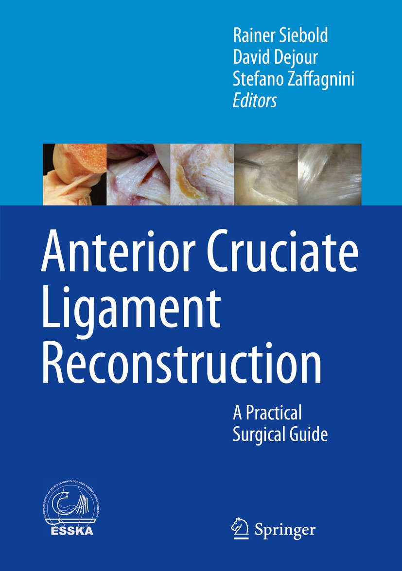 Titlebook: Anterior Cruciate Ligament Reconstruction; A Practical Surgical Rainer Siebold,David Dejour,Stefano Zaffagnini Book 2014 Springer-Verlag Gm Titlebook: Anterior Cruciate Ligament Reconstruction; A Practical Surgical Rainer Siebold,David Dejour,Stefano Zaffagnini Book 2014 Springer-Verlag Gm