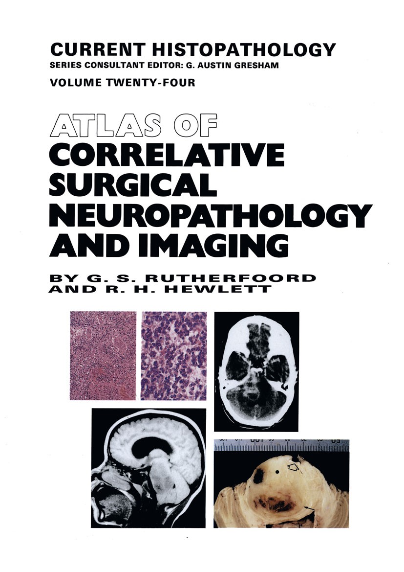 Titlebook: Atlas of Correlative Surgical Neuropathology and Imaging; G. Stuart Rutherfoord,R. H. Hewlett Book 1994 G.S. Rutherfoord and R.H. Hewlett Titlebook: Atlas of Correlative Surgical Neuropathology and Imaging; G. Stuart Rutherfoord,R. H. Hewlett Book 1994 G.S. Rutherfoord and R.H. Hewlett