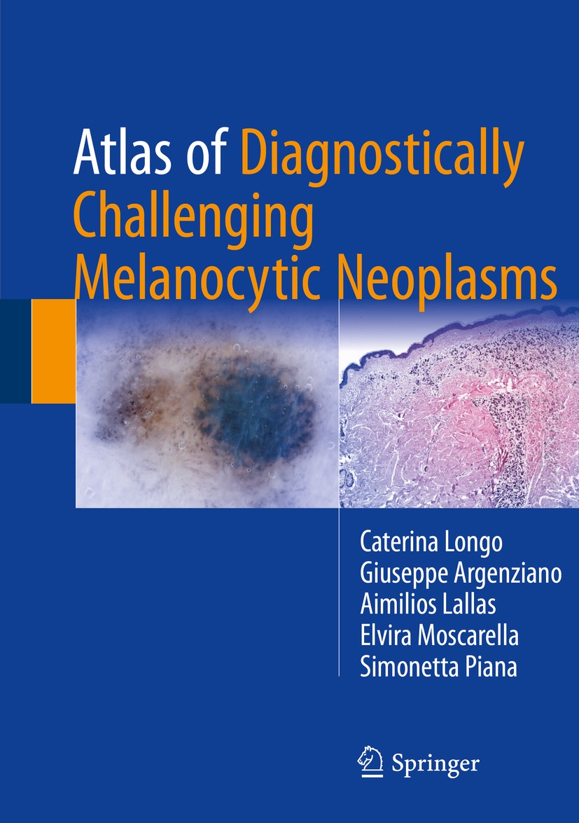 Titlebook: Atlas of Diagnostically Challenging Melanocytic Neoplasms; Caterina Longo,Giuseppe Argenziano,Simonetta Piana Book 2018 Springer Internati Titlebook: Atlas of Diagnostically Challenging Melanocytic Neoplasms; Caterina Longo,Giuseppe Argenziano,Simonetta Piana Book 2018 Springer Internati