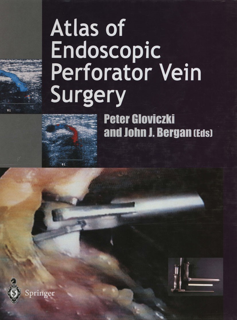Titlebook: Atlas of Endoscopic Perforator Vein Surgery; Peter Gloviczki (Professor of Surgery, Vice-Chair) Book 1998 Springer-Verlag London Limited 1 Titlebook: Atlas of Endoscopic Perforator Vein Surgery; Peter Gloviczki (Professor of Surgery, Vice-Chair) Book 1998 Springer-Verlag London Limited 1