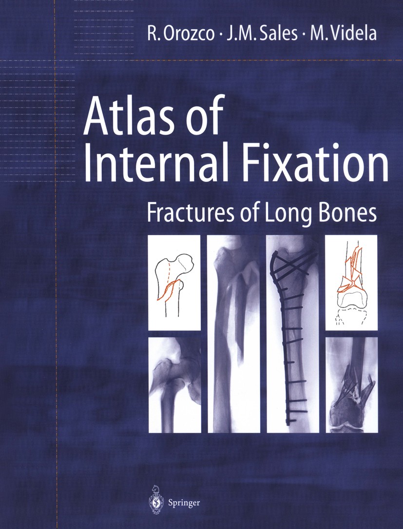 Titlebook: Atlas of Internal Fixation; Fractures of Long Bo Rafael Orozco,J. Miquel Sales,Miquel Videla Book 2000 Springer-Verlag Berlin Heidelberg 20 Titlebook: Atlas of Internal Fixation; Fractures of Long Bo Rafael Orozco,J. Miquel Sales,Miquel Videla Book 2000 Springer-Verlag Berlin Heidelberg 20