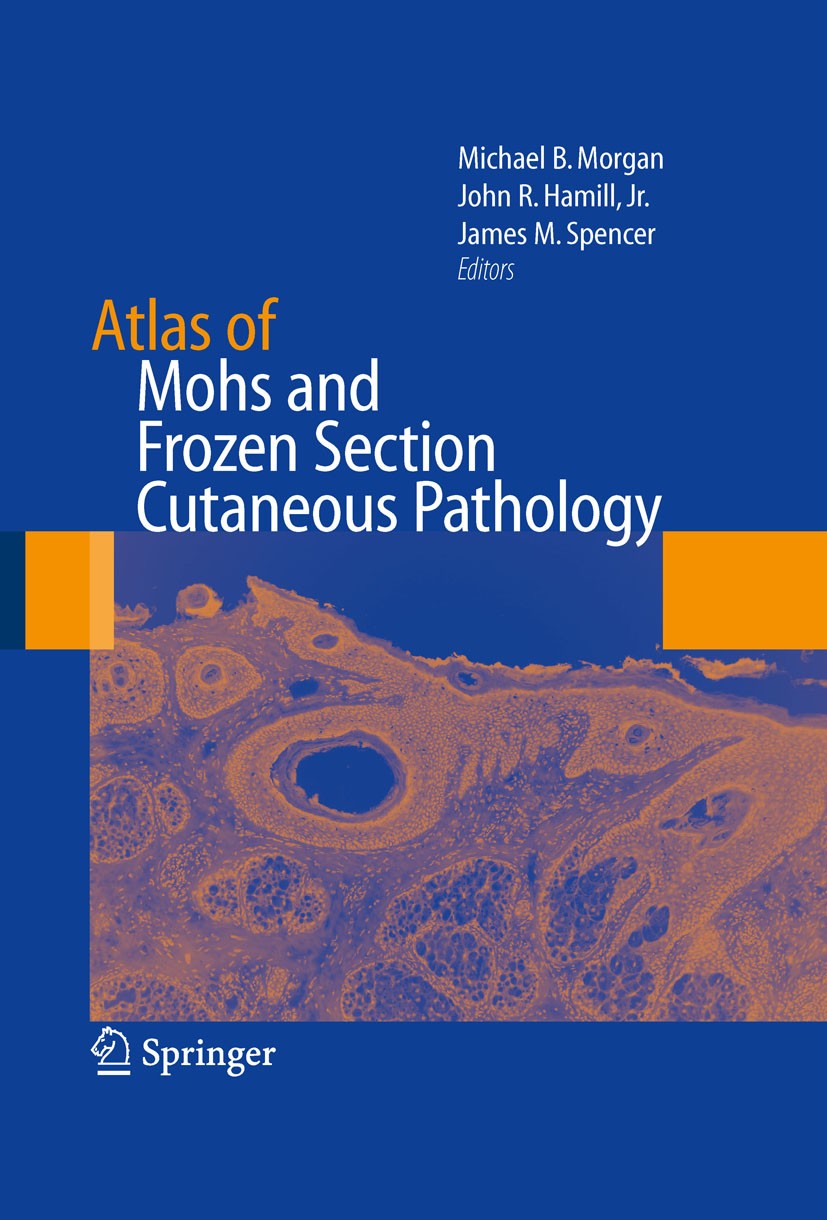Titlebook: Atlas of Mohs and Frozen Section Cutaneous Pathology; Michael‘Morgan,John R. Hamill,James M. Spencer Book 20101st edition Springer-Verlag Titlebook: Atlas of Mohs and Frozen Section Cutaneous Pathology; Michael‘Morgan,John R. Hamill,James M. Spencer Book 20101st edition Springer-Verlag