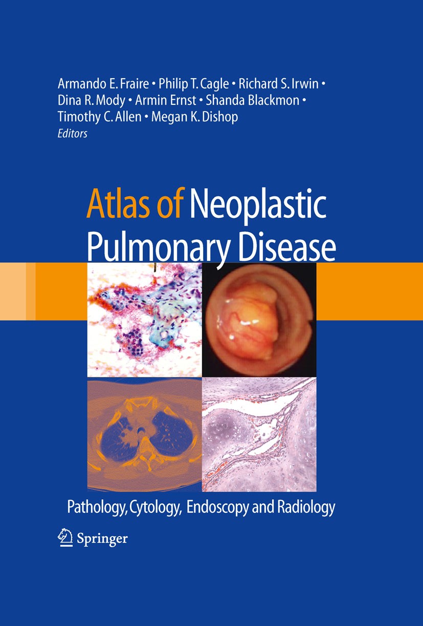 Titlebook: Atlas of Neoplastic Pulmonary Disease; Pathology, Cytology, Armando E. Fraire,Philip T. Cagle,Megan K. Dishop Book 2010 Springer-Verlag US Titlebook: Atlas of Neoplastic Pulmonary Disease; Pathology, Cytology, Armando E. Fraire,Philip T. Cagle,Megan K. Dishop Book 2010 Springer-Verlag US