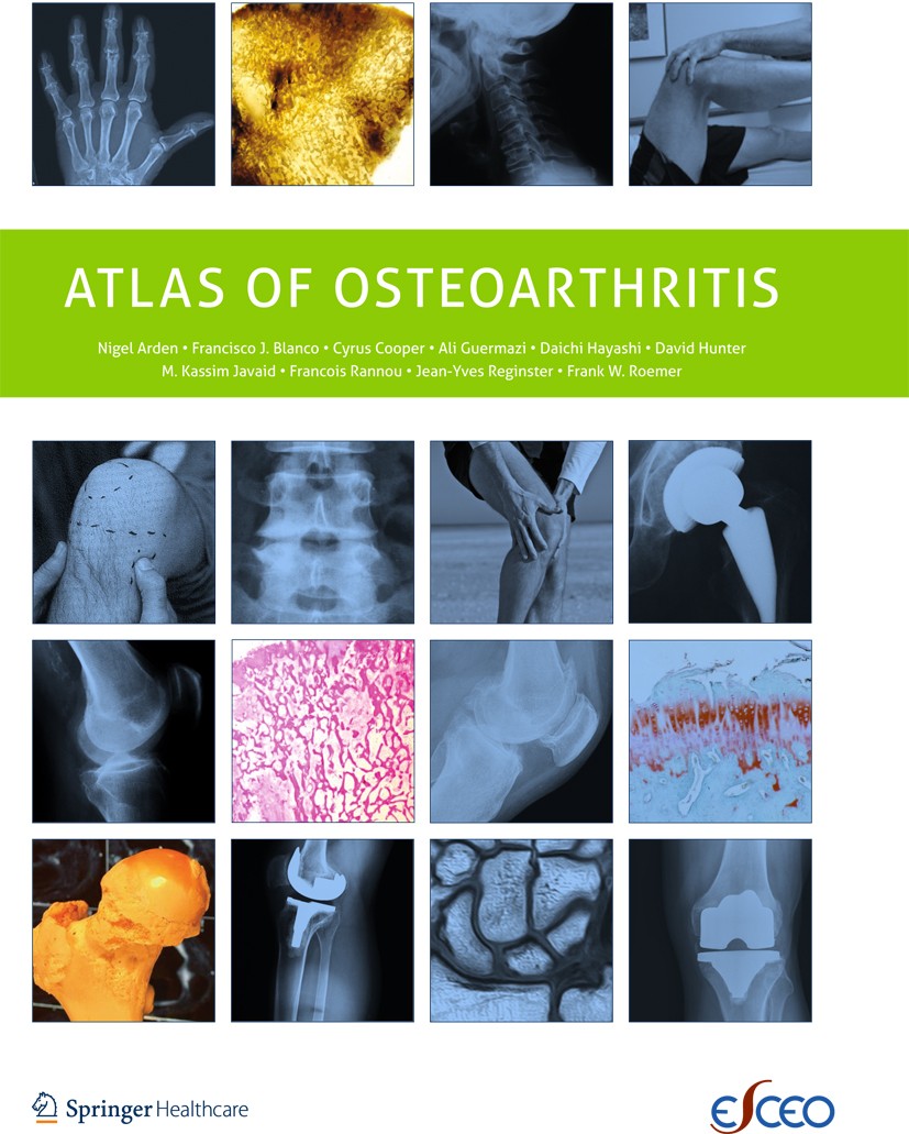 Titlebook: Atlas of Osteoarthritis; Nigel Arden,Francisco Blanco,Jean-Yves Reginster Book 2014 Springer Healthcare 2014 Arthritis.Medicine.Osteoarthr Titlebook: Atlas of Osteoarthritis; Nigel Arden,Francisco Blanco,Jean-Yves Reginster Book 2014 Springer Healthcare 2014 Arthritis.Medicine.Osteoarthr