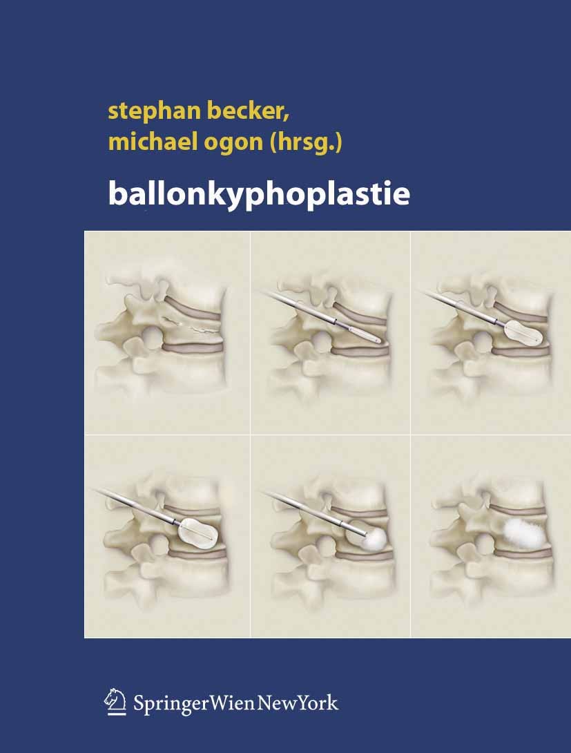 Titlebook: Ballonkyphoplastie; Stephan Becker,Michael Ogon Book 2006 Springer-Verlag Vienna 2006 Anatomie.Biomechanik.Epidemiologie.Fraktur.Klassifik Titlebook: Ballonkyphoplastie; Stephan Becker,Michael Ogon Book 2006 Springer-Verlag Vienna 2006 Anatomie.Biomechanik.Epidemiologie.Fraktur.Klassifik