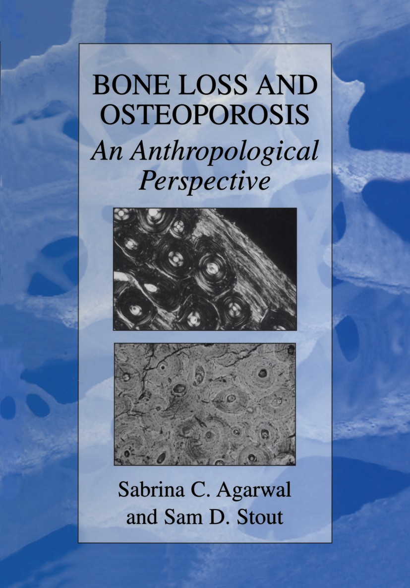 Titlebook: Bone Loss and Osteoporosis; An Anthropological P Sabrina C. Agarwal,Sam D. Stout Book 2003 Springer Science+Business Media New York 2003 Tu Titlebook: Bone Loss and Osteoporosis; An Anthropological P Sabrina C. Agarwal,Sam D. Stout Book 2003 Springer Science+Business Media New York 2003 Tu