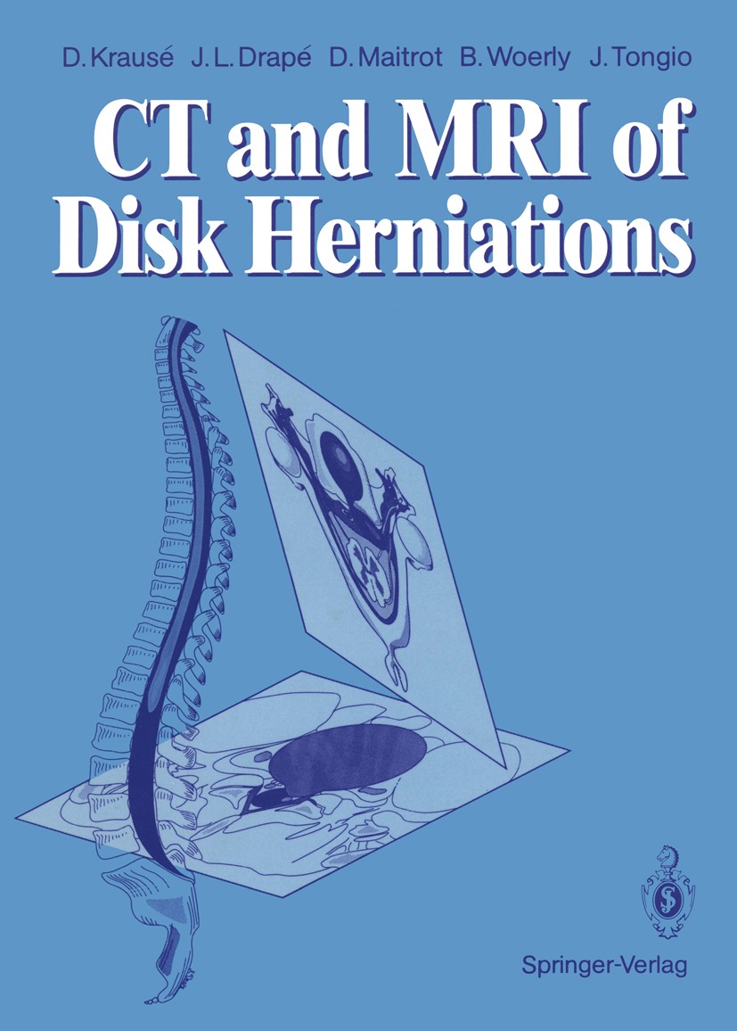 Titlebook: CT and MRI of Disk Herniations; Denis Krausé,Jean Luc Drapé,Jean Tongio Book 1991 Springer-Verlag Berlin Heidelberg 1991 Bandscheibe.Rücke Titlebook: CT and MRI of Disk Herniations; Denis Krausé,Jean Luc Drapé,Jean Tongio Book 1991 Springer-Verlag Berlin Heidelberg 1991 Bandscheibe.Rücke