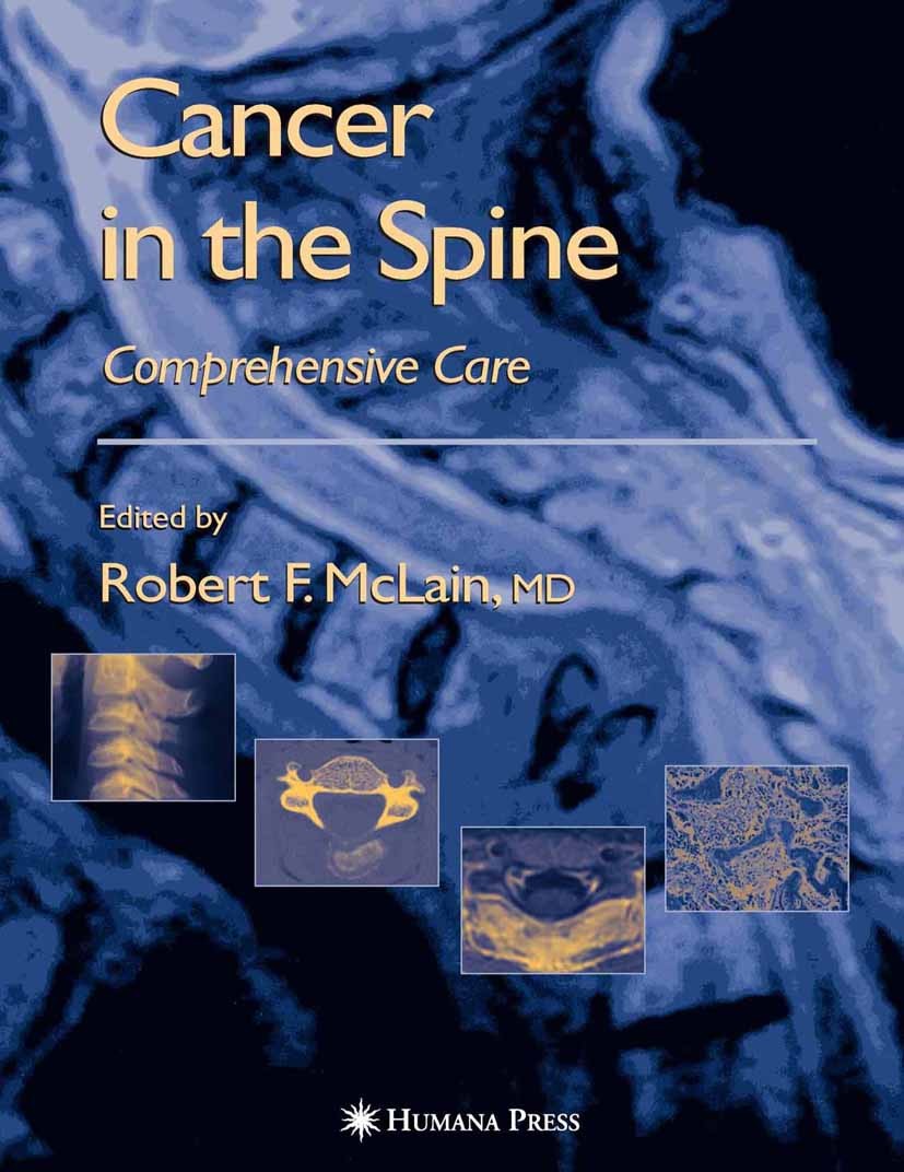 Titlebook: Cancer in the Spine; Comprehensive Care Robert F. McLain,Kai-Uwe Lewandrowski,Edward C. Be Book 2006 Humana Press 2006 biopsy.carcinoma.dec Titlebook: Cancer in the Spine; Comprehensive Care Robert F. McLain,Kai-Uwe Lewandrowski,Edward C. Be Book 2006 Humana Press 2006 biopsy.carcinoma.dec