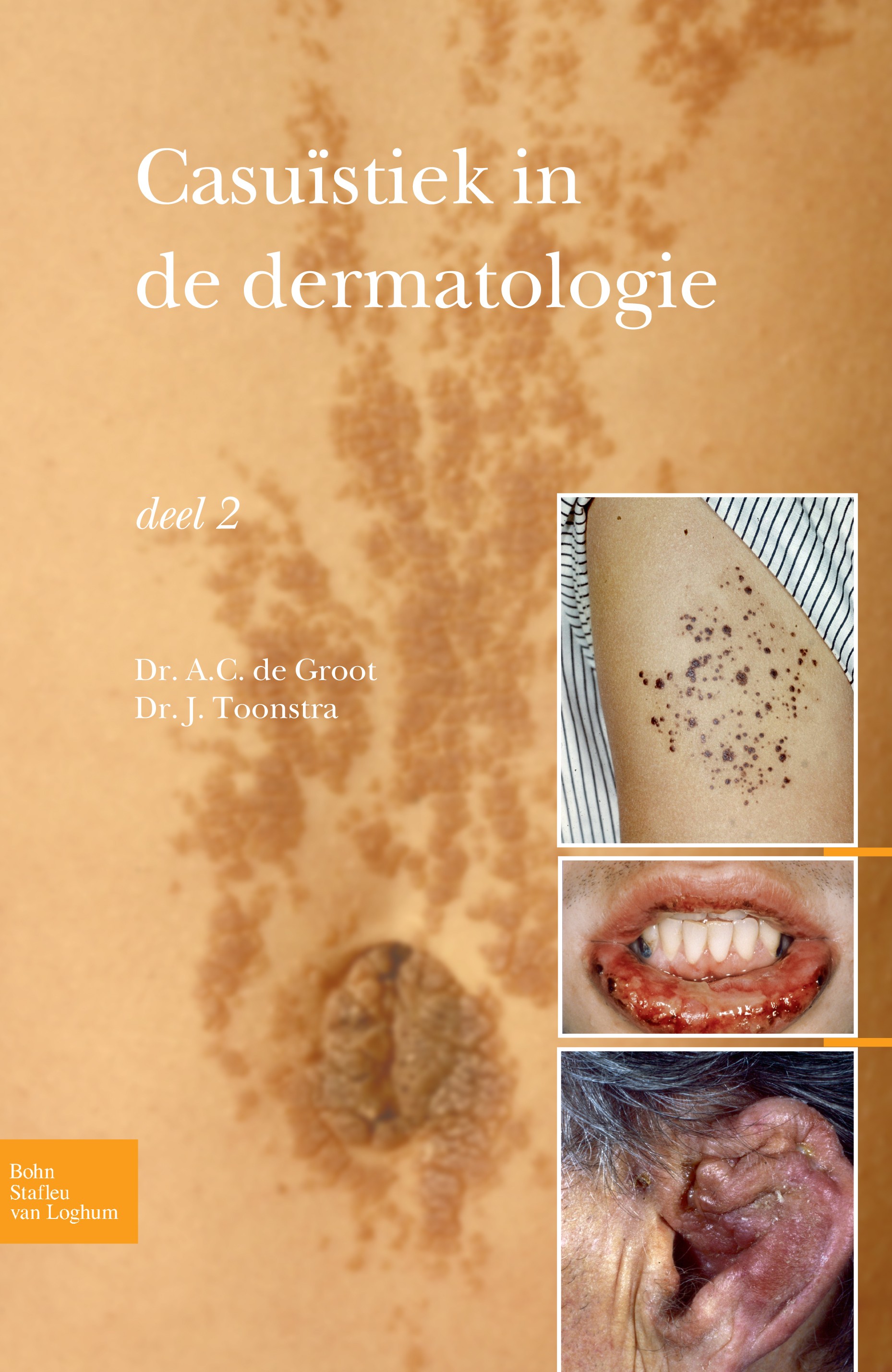 Titlebook: Casuïstiek in de dermatologie - deel 2; A. C. Groot,J. Toonstra Book 2010Latest edition Bohn Stafleu van Loghum 2010 Titlebook: Casuïstiek in de dermatologie - deel 2; A. C. Groot,J. Toonstra Book 2010Latest edition Bohn Stafleu van Loghum 2010
