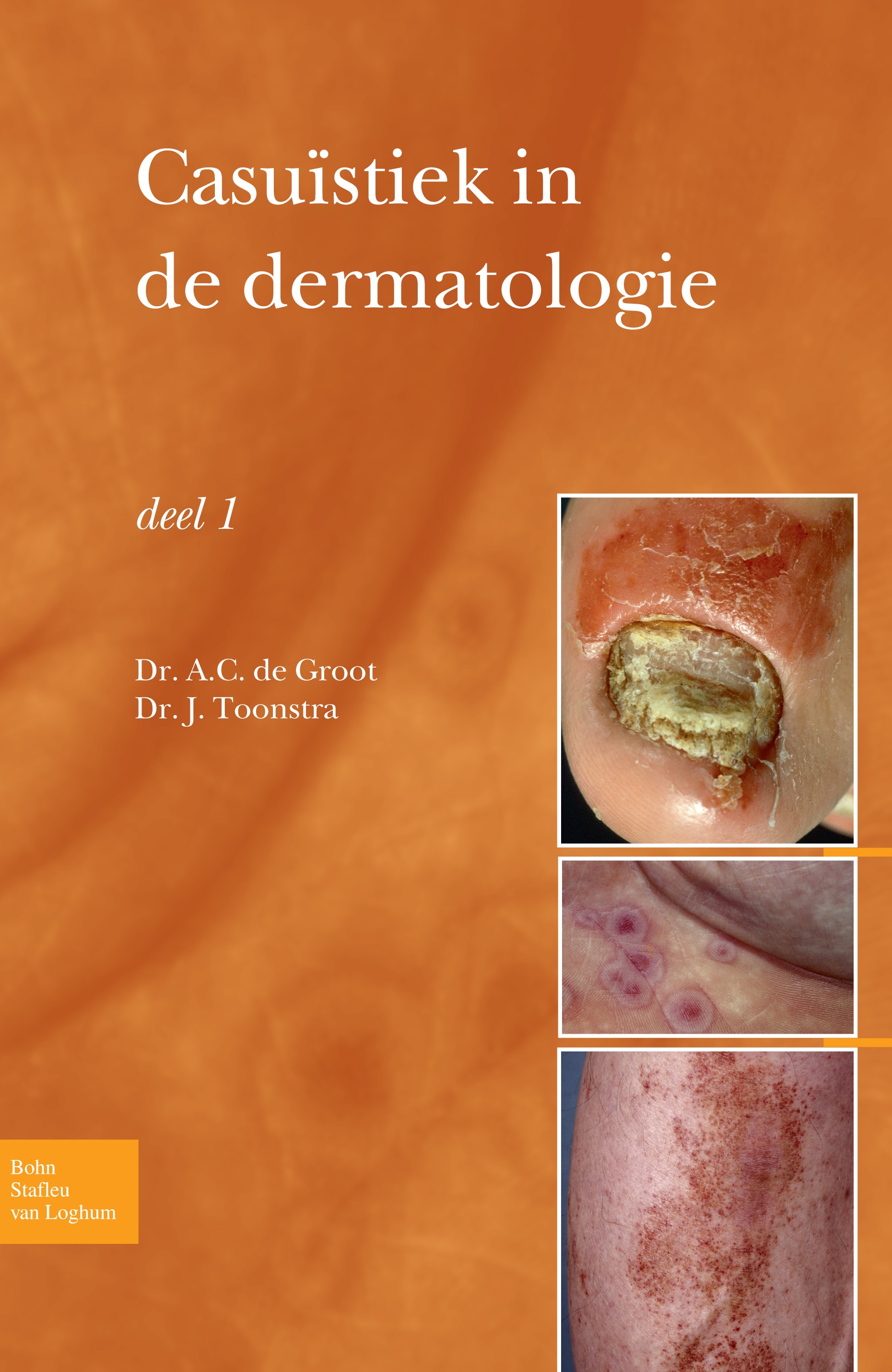 Titlebook: Casuïstiek in de dermatologie - deel I; A. C. Groot,J. Toonstra Book 2009Latest edition Bohn Stafleu van Loghum 2009 Titlebook: Casuïstiek in de dermatologie - deel I; A. C. Groot,J. Toonstra Book 2009Latest edition Bohn Stafleu van Loghum 2009