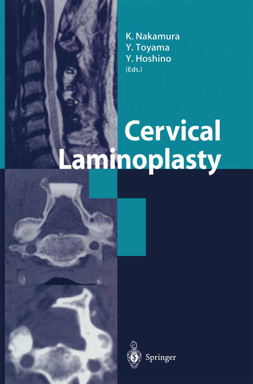 Titlebook: Cervical Laminoplasty; Kozo Nakamura (Professor and Director),Yoshiaki To Book 2003 Springer Japan 2003 Cervical Myelopathy.Cervical spine Titlebook: Cervical Laminoplasty; Kozo Nakamura (Professor and Director),Yoshiaki To Book 2003 Springer Japan 2003 Cervical Myelopathy.Cervical spine