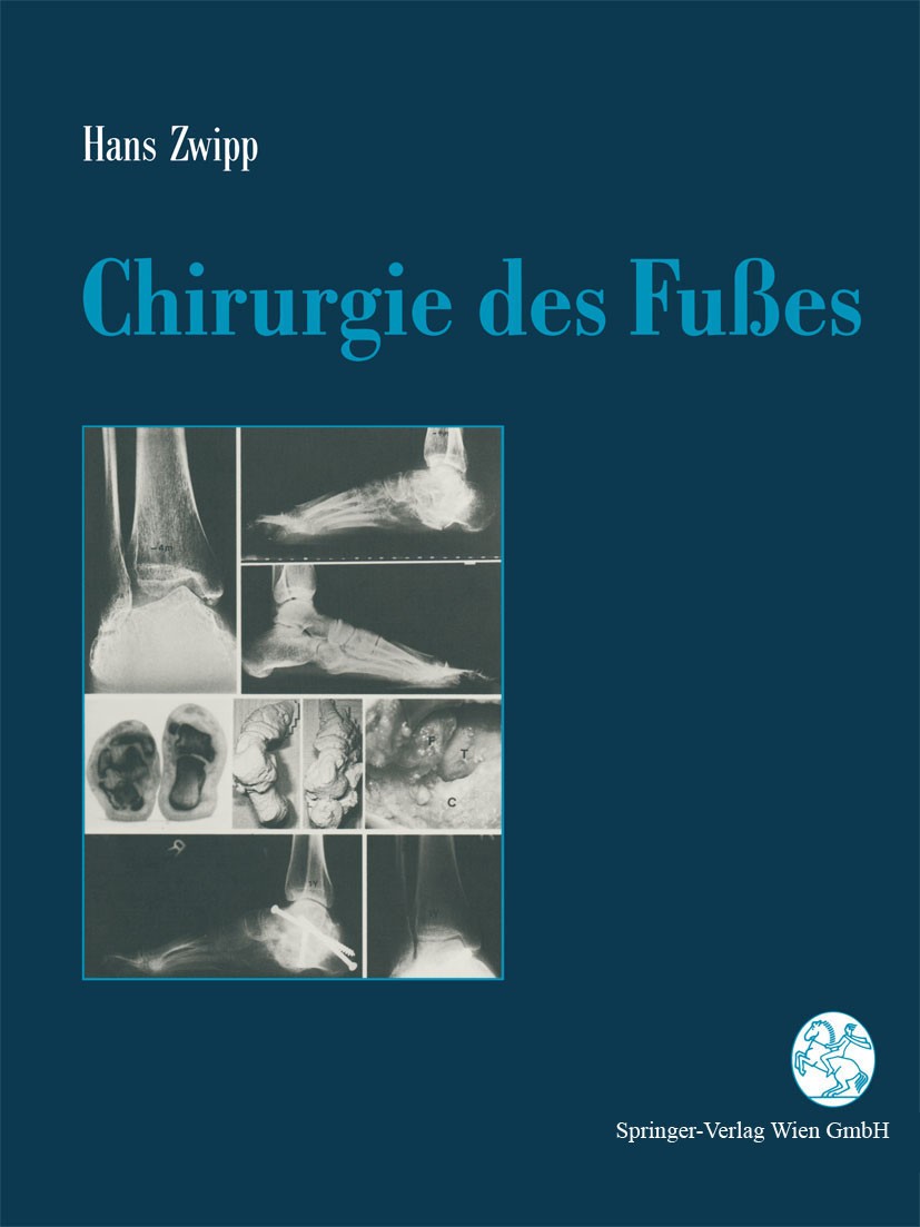 Titlebook: Chirurgie des Fußes; Hans Zwipp Book 1994 Springer-Verlag Wien 1994 Anatomie.Chirurgie.Computertomographie (CT).Fuß.Sonographie.Traumatolo Titlebook: Chirurgie des Fußes; Hans Zwipp Book 1994 Springer-Verlag Wien 1994 Anatomie.Chirurgie.Computertomographie (CT).Fuß.Sonographie.Traumatolo