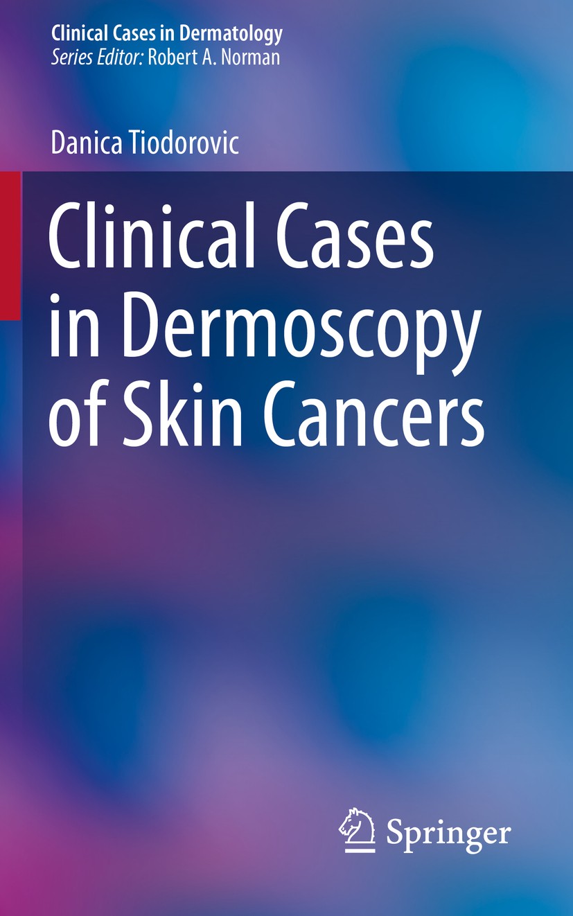 Titlebook: Clinical Cases in Dermoscopy of Skin Cancers; Danica Tiodorovic Book 2020 Springer Nature Switzerland AG 2020 Basal Cell Carcinoma.Squamou Titlebook: Clinical Cases in Dermoscopy of Skin Cancers; Danica Tiodorovic Book 2020 Springer Nature Switzerland AG 2020 Basal Cell Carcinoma.Squamou