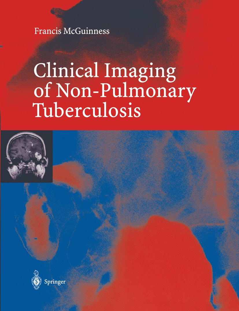 Titlebook: Clinical Imaging in Non-Pulmonary Tuberculosis; Francis E. McGuinness Book 2000 Springer-Verlag Berlin Heidelberg 2000 Gastroenterological Titlebook: Clinical Imaging in Non-Pulmonary Tuberculosis; Francis E. McGuinness Book 2000 Springer-Verlag Berlin Heidelberg 2000 Gastroenterological