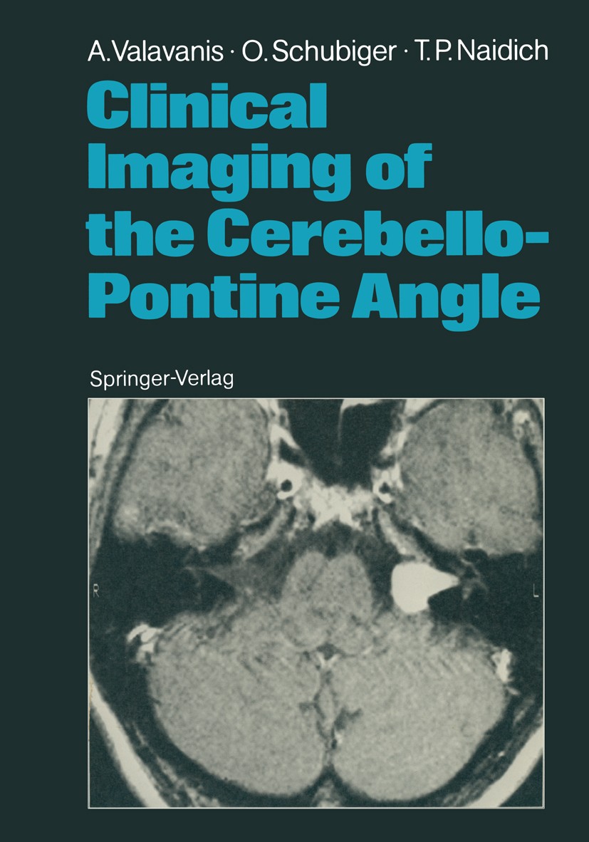 Titlebook: Clinical Imaging of the Cerebello-Pontine Angle; Anton Valavanis,Othmar Schubiger,Thomas P. Naidich Book 1987 Springer-Verlag Berlin Heide Titlebook: Clinical Imaging of the Cerebello-Pontine Angle; Anton Valavanis,Othmar Schubiger,Thomas P. Naidich Book 1987 Springer-Verlag Berlin Heide