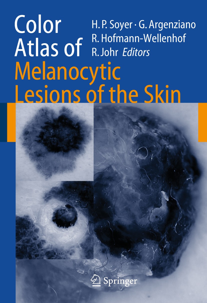 Titlebook: Color Atlas of Melanocytic Lesions of the Skin; Hans Peter Soyer,Guiseppe Argenziano,Robert H. Joh Book 2007 Springer-Verlag Berlin Heidel Titlebook: Color Atlas of Melanocytic Lesions of the Skin; Hans Peter Soyer,Guiseppe Argenziano,Robert H. Joh Book 2007 Springer-Verlag Berlin Heidel