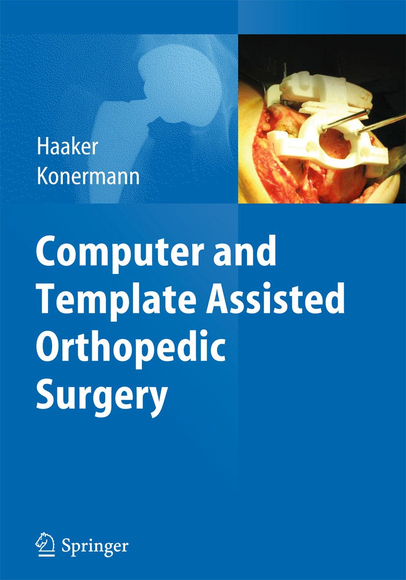 Titlebook: Computer and Template Assisted Orthopedic Surgery; Rolf Haaker,Werner Konermann Book 2013 Springer-Verlag Berlin Heidelberg 2013 Titlebook: Computer and Template Assisted Orthopedic Surgery; Rolf Haaker,Werner Konermann Book 2013 Springer-Verlag Berlin Heidelberg 2013