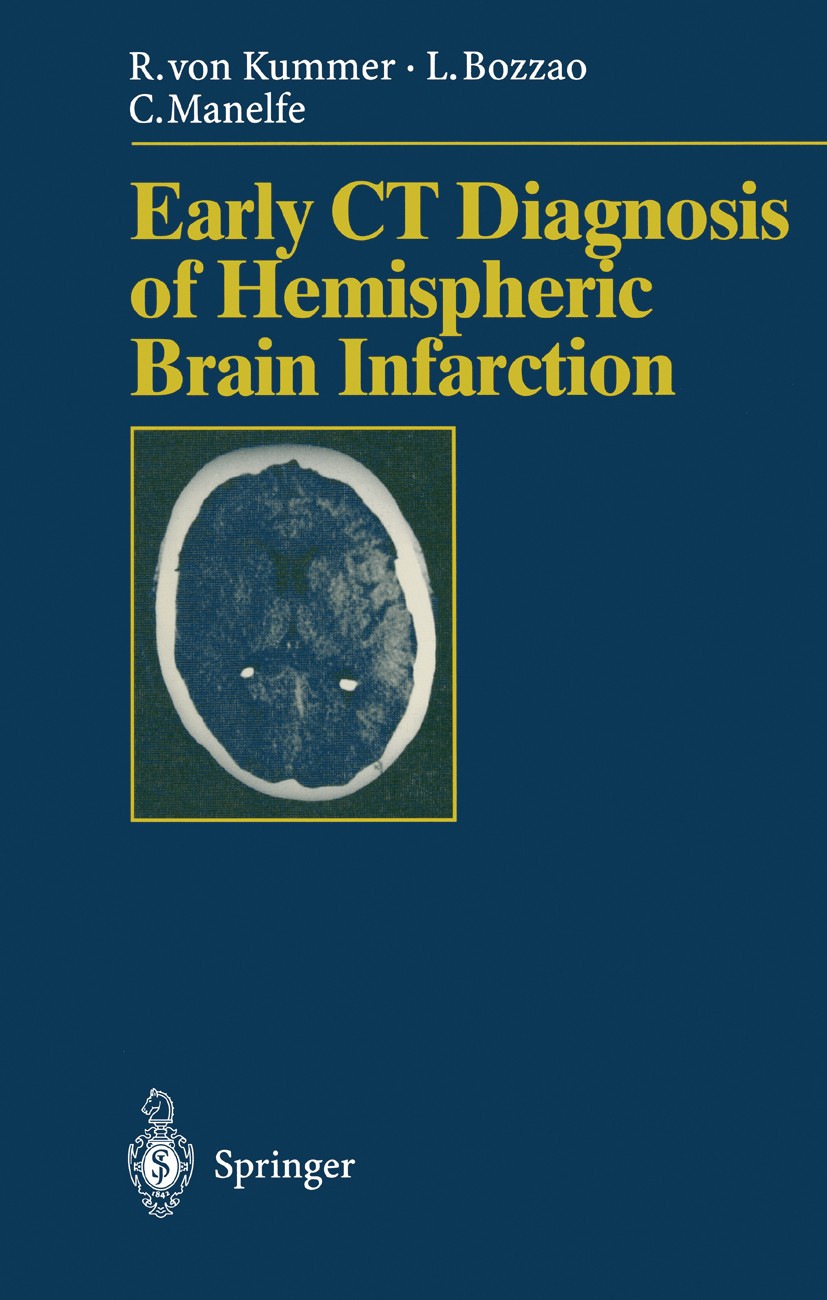 Titlebook: Early CT Diagnosis of Hemispheric Brain Infarction; Rüdiger Kummer,Luigi Bozzao,H. Zeumer Book 1995 Springer-Verlag Berlin Heidelberg 1995 Titlebook: Early CT Diagnosis of Hemispheric Brain Infarction; Rüdiger Kummer,Luigi Bozzao,H. Zeumer Book 1995 Springer-Verlag Berlin Heidelberg 1995