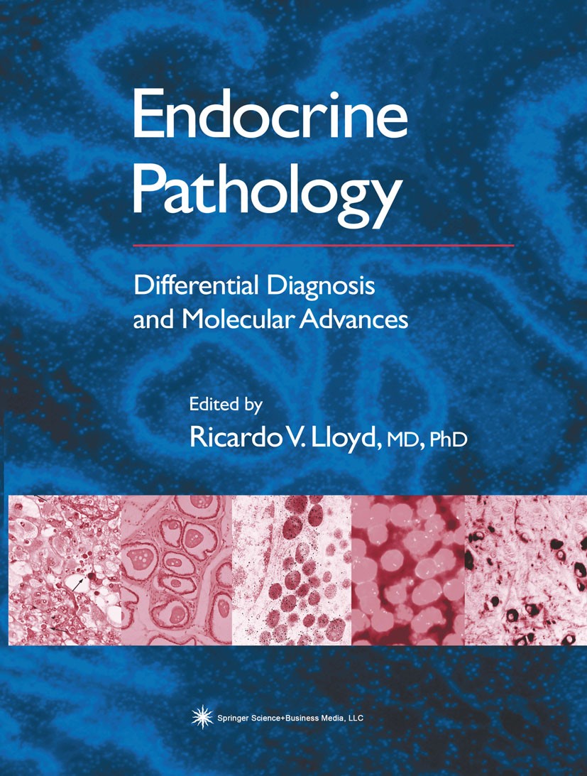 Titlebook: Endocrine Pathology; Differential Diagnos Ricardo V. Lloyd Book 2004 Springer Science+Business Media New York 2004 Diagnostic Pathology.End Titlebook: Endocrine Pathology; Differential Diagnos Ricardo V. Lloyd Book 2004 Springer Science+Business Media New York 2004 Diagnostic Pathology.End