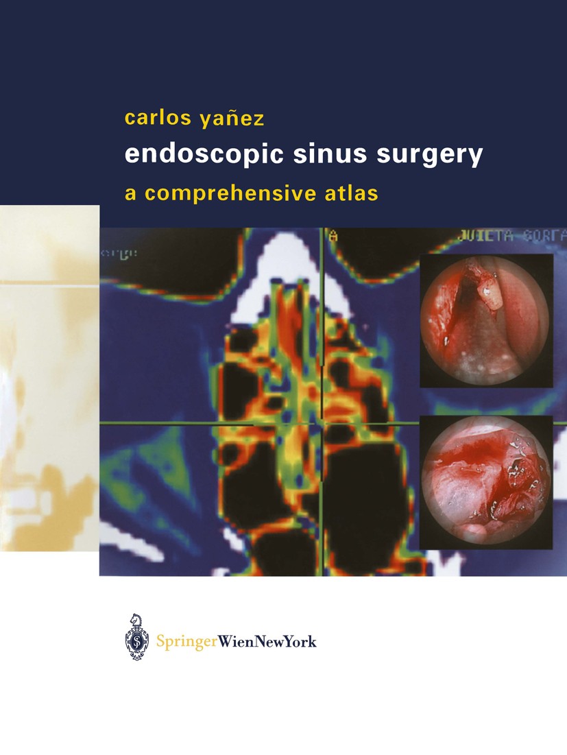 Titlebook: Endoscopic Sinus Surgery; A Comprehensive Atla Carlos Yañez Book 2003 Springer-Verlag Wien 2003 ENT surgery.Surgery.endoscopic sinus surger Titlebook: Endoscopic Sinus Surgery; A Comprehensive Atla Carlos Yañez Book 2003 Springer-Verlag Wien 2003 ENT surgery.Surgery.endoscopic sinus surger