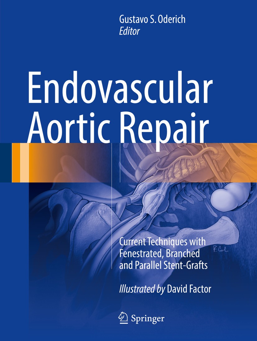 Titlebook: Endovascular Aortic Repair; Current Techniques w Gustavo S. Oderich Book 2017 Mayo Foundation for Medical Education and Research 2017 arch Titlebook: Endovascular Aortic Repair; Current Techniques w Gustavo S. Oderich Book 2017 Mayo Foundation for Medical Education and Research 2017 arch