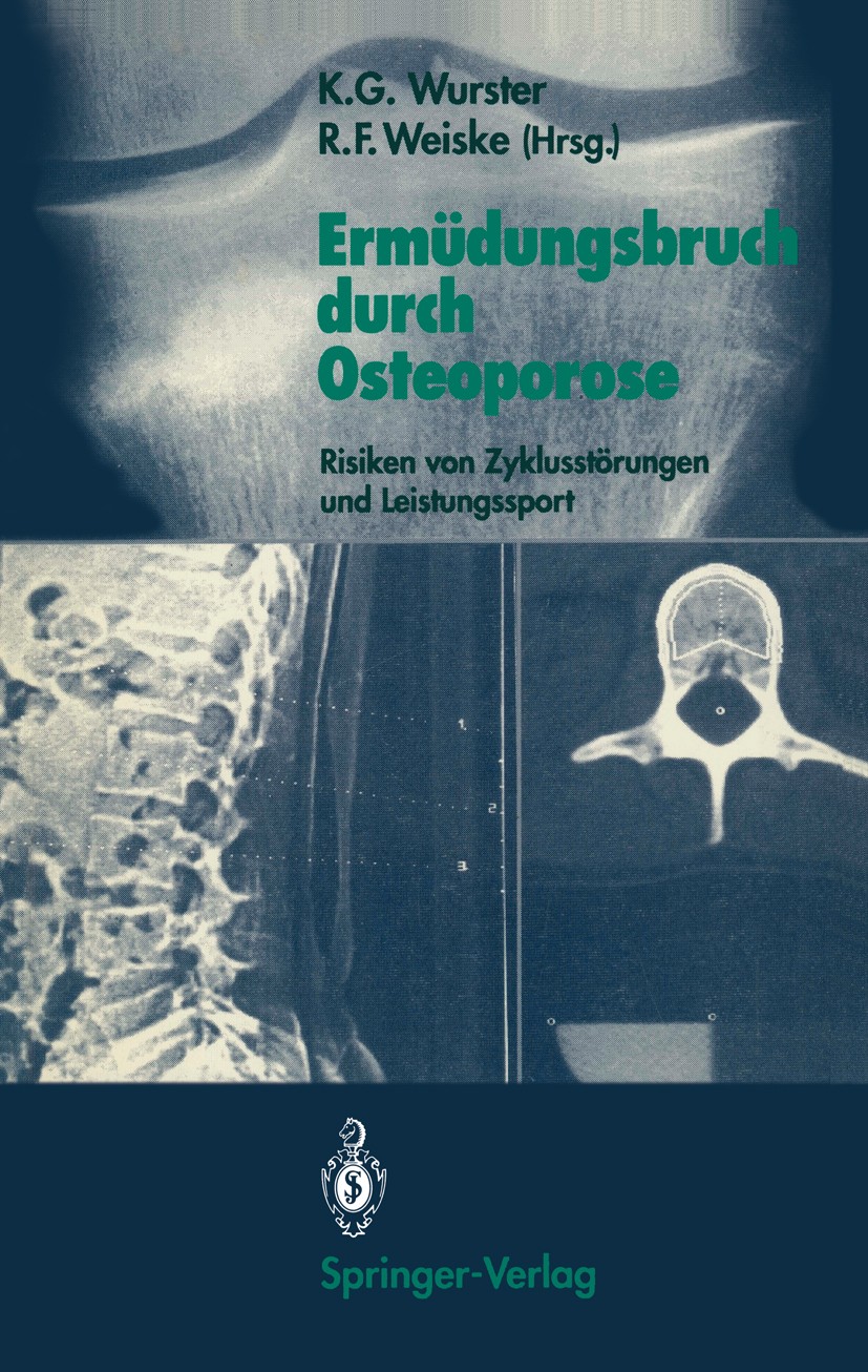 Titlebook: Ermüdungsbruch durch Osteoporose; Risiken von Zyklusst Kurt Götz Wurster (Leitender Arzt an der Frauenkli Conference proceedings 1991 Sprin Titlebook: Ermüdungsbruch durch Osteoporose; Risiken von Zyklusst Kurt Götz Wurster (Leitender Arzt an der Frauenkli Conference proceedings 1991 Sprin