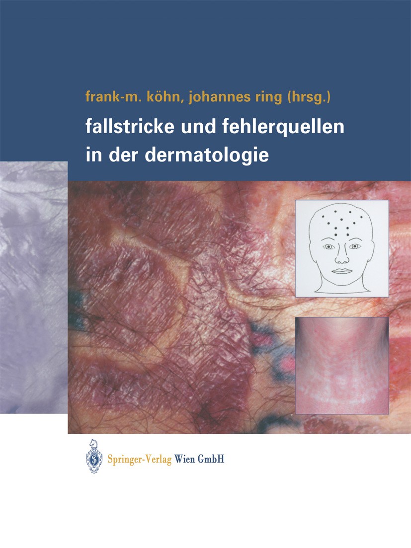 Titlebook: Fallstricke und Fehlerquellen in der Dermatologie; Frank-M. Köhn,Johannes Ring Book 2004 Springer-Verlag Wien 2004 Allergie.Allergologie.A Titlebook: Fallstricke und Fehlerquellen in der Dermatologie; Frank-M. Köhn,Johannes Ring Book 2004 Springer-Verlag Wien 2004 Allergie.Allergologie.A