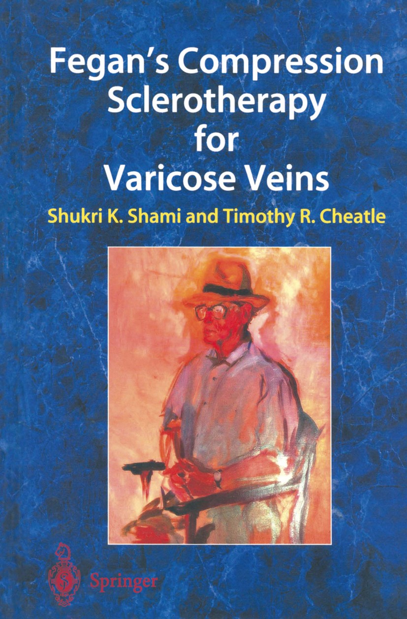 Titlebook: Fegan’s Compression Sclerotherapy for Varicose Veins; Shukri K. Shami (Consultant Vascular Surgeon),Timo Book 2003 Springer-Verlag London Titlebook: Fegan’s Compression Sclerotherapy for Varicose Veins; Shukri K. Shami (Consultant Vascular Surgeon),Timo Book 2003 Springer-Verlag London