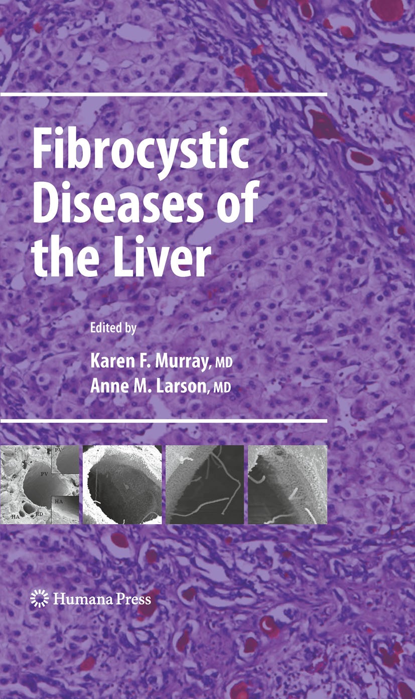 Titlebook: Fibrocystic Diseases of the Liver; Karen F. Murray,Anne M. Larson Book 2010 Springer Science+Business Media, LLC 2010 Cholangiocyte.Cystad Titlebook: Fibrocystic Diseases of the Liver; Karen F. Murray,Anne M. Larson Book 2010 Springer Science+Business Media, LLC 2010 Cholangiocyte.Cystad