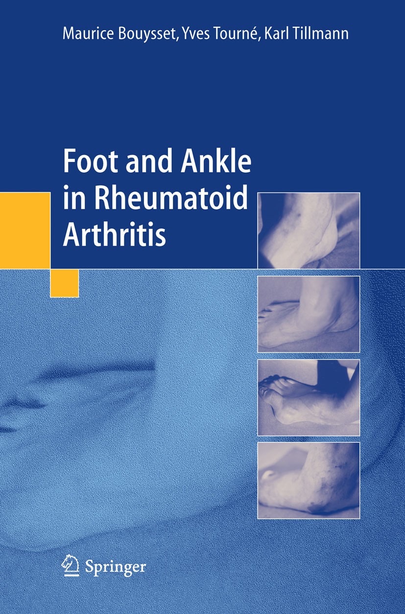 Titlebook: Foot and ankle in rheumatoid arthritis; Maurice Bouysset,Yves Tourné,Karl Tillmann Textbook 2006 Springer-Verlag France SAS 2006 Arthritis Titlebook: Foot and ankle in rheumatoid arthritis; Maurice Bouysset,Yves Tourné,Karl Tillmann Textbook 2006 Springer-Verlag France SAS 2006 Arthritis