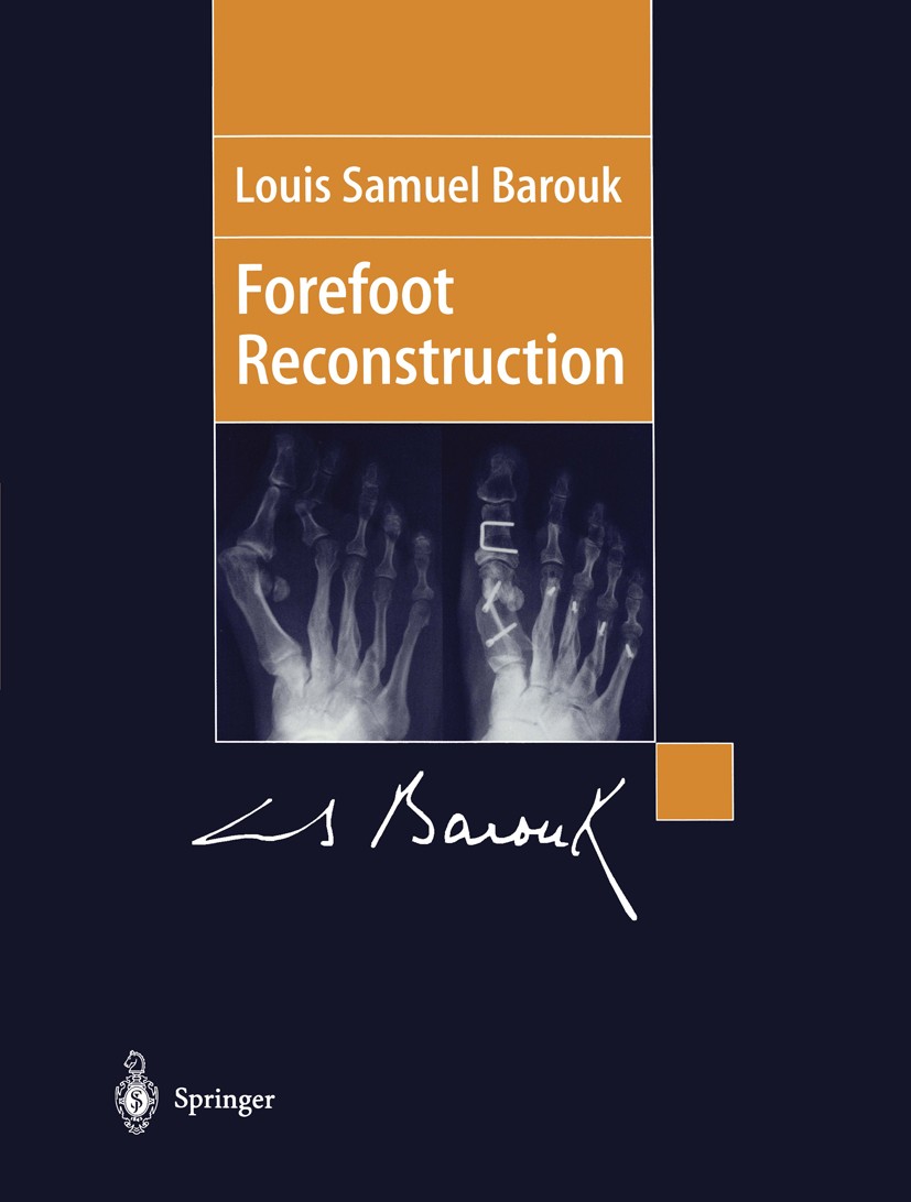 Titlebook: Forefoot Reconstruction; Louis Samuel Barouk Book 20031st edition Springer-Verlag Paris 2003 Forefoot.Postopearitve management.hand.implan Titlebook: Forefoot Reconstruction; Louis Samuel Barouk Book 20031st edition Springer-Verlag Paris 2003 Forefoot.Postopearitve management.hand.implan