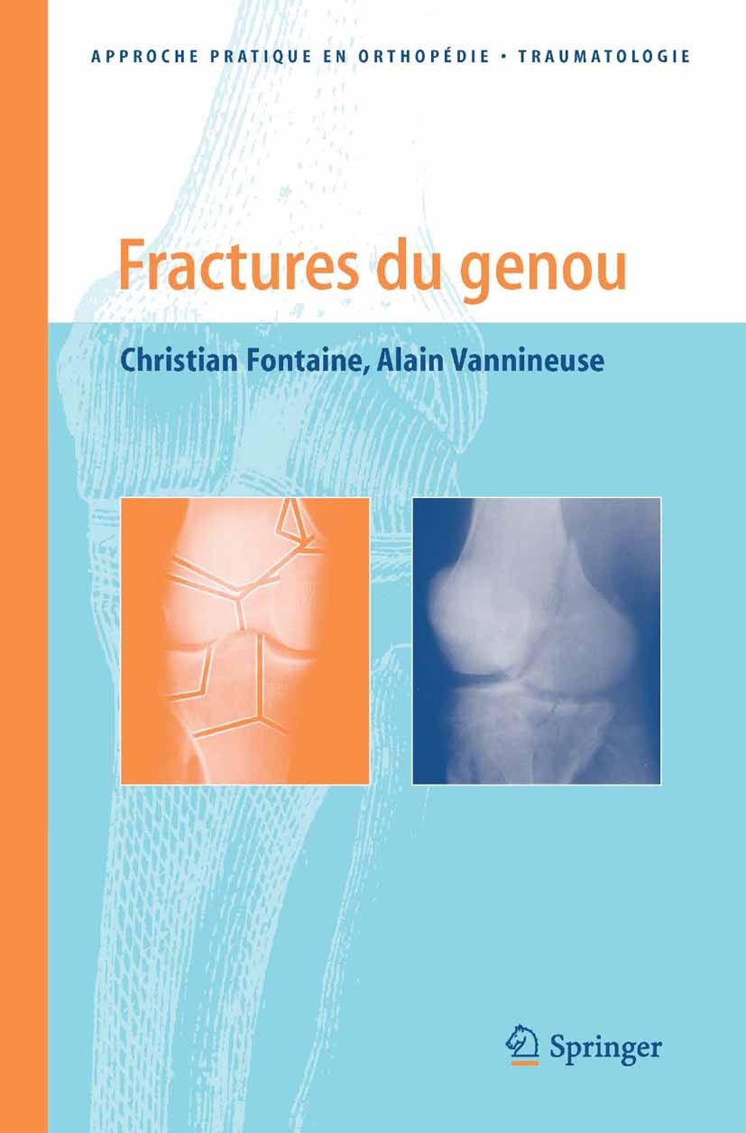Titlebook: Fractures du genou; Christian Fontaine,Alain Vannineuse Book 2005Latest edition Springer-Verlag Paris 2005 Arthrose.appareil extenseur.fra Titlebook: Fractures du genou; Christian Fontaine,Alain Vannineuse Book 2005Latest edition Springer-Verlag Paris 2005 Arthrose.appareil extenseur.fra