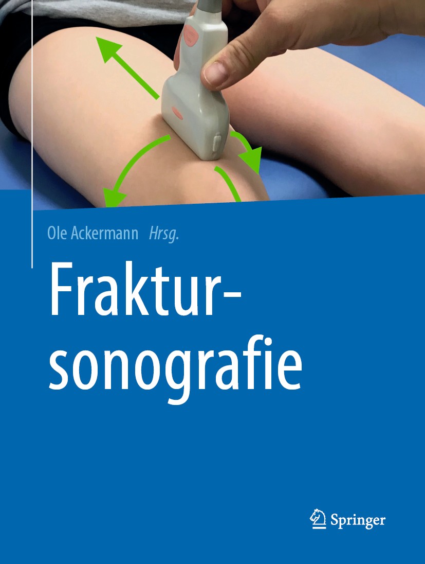 Titlebook: Fraktursonografie; Ole Ackermann Book 2019 Springer-Verlag GmbH Deutschland, ein Teil von Springer Nature 2019 Schädelfraktur.Claviculafra Titlebook: Fraktursonografie; Ole Ackermann Book 2019 Springer-Verlag GmbH Deutschland, ein Teil von Springer Nature 2019 Schädelfraktur.Claviculafra