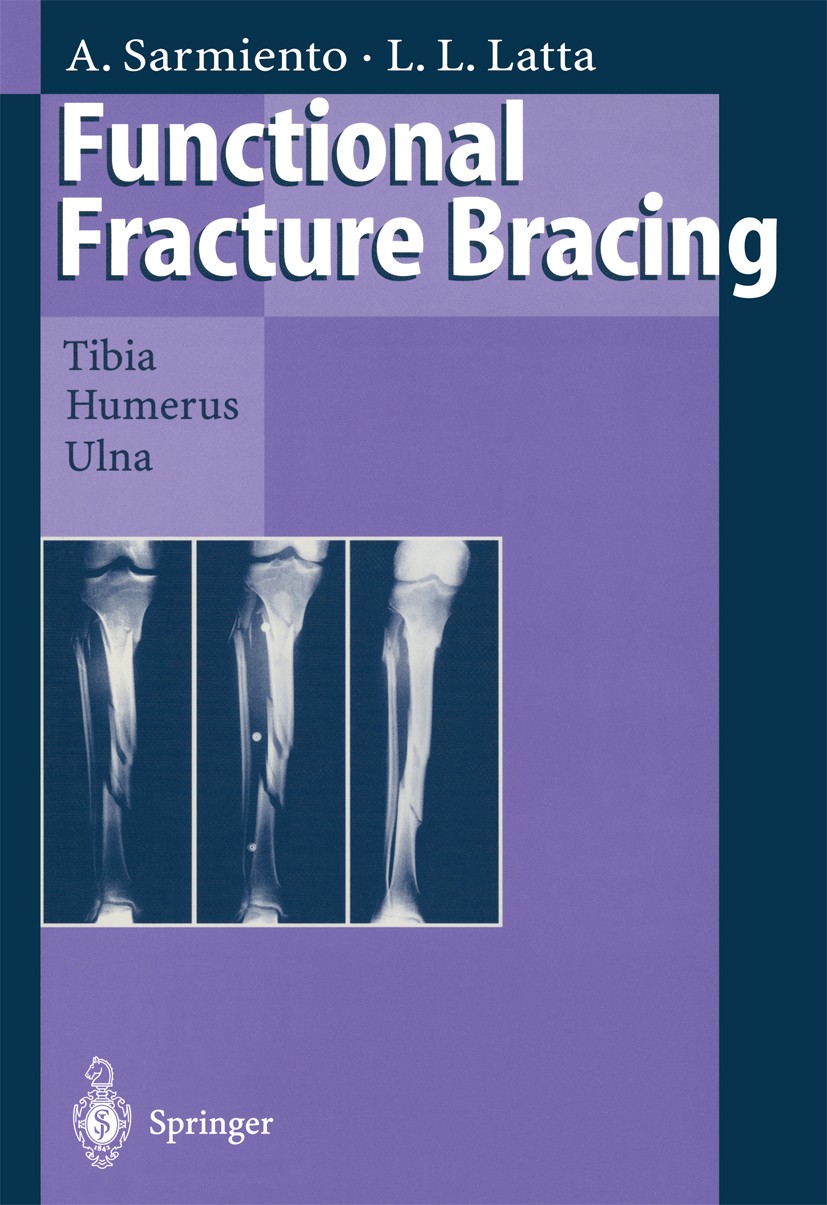 Titlebook: Functional Fracture Bracing; Tibia, Humerus, and Augusto Sarmiento,Loren L. Latta Book 1995 Springer-Verlag Berlin Heidelberg 1995 Functio Titlebook: Functional Fracture Bracing; Tibia, Humerus, and Augusto Sarmiento,Loren L. Latta Book 1995 Springer-Verlag Berlin Heidelberg 1995 Functio