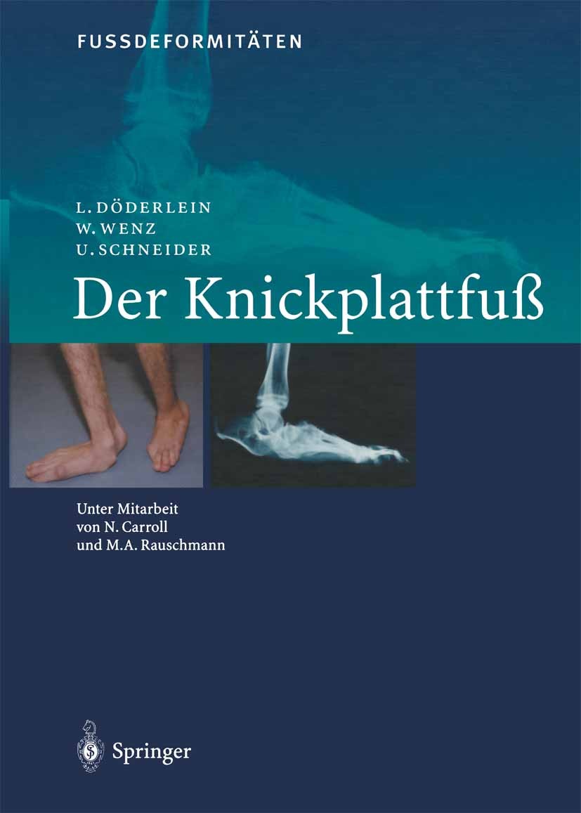 Titlebook: FussdeformitÄten; Der Knickplattfuss Leonhard Döderlein,Wolfram Wenz,Urs Schneider Book 2002 Springer-Verlag Berlin Heidelberg 2002 Biomech Titlebook: FussdeformitÄten; Der Knickplattfuss Leonhard Döderlein,Wolfram Wenz,Urs Schneider Book 2002 Springer-Verlag Berlin Heidelberg 2002 Biomech