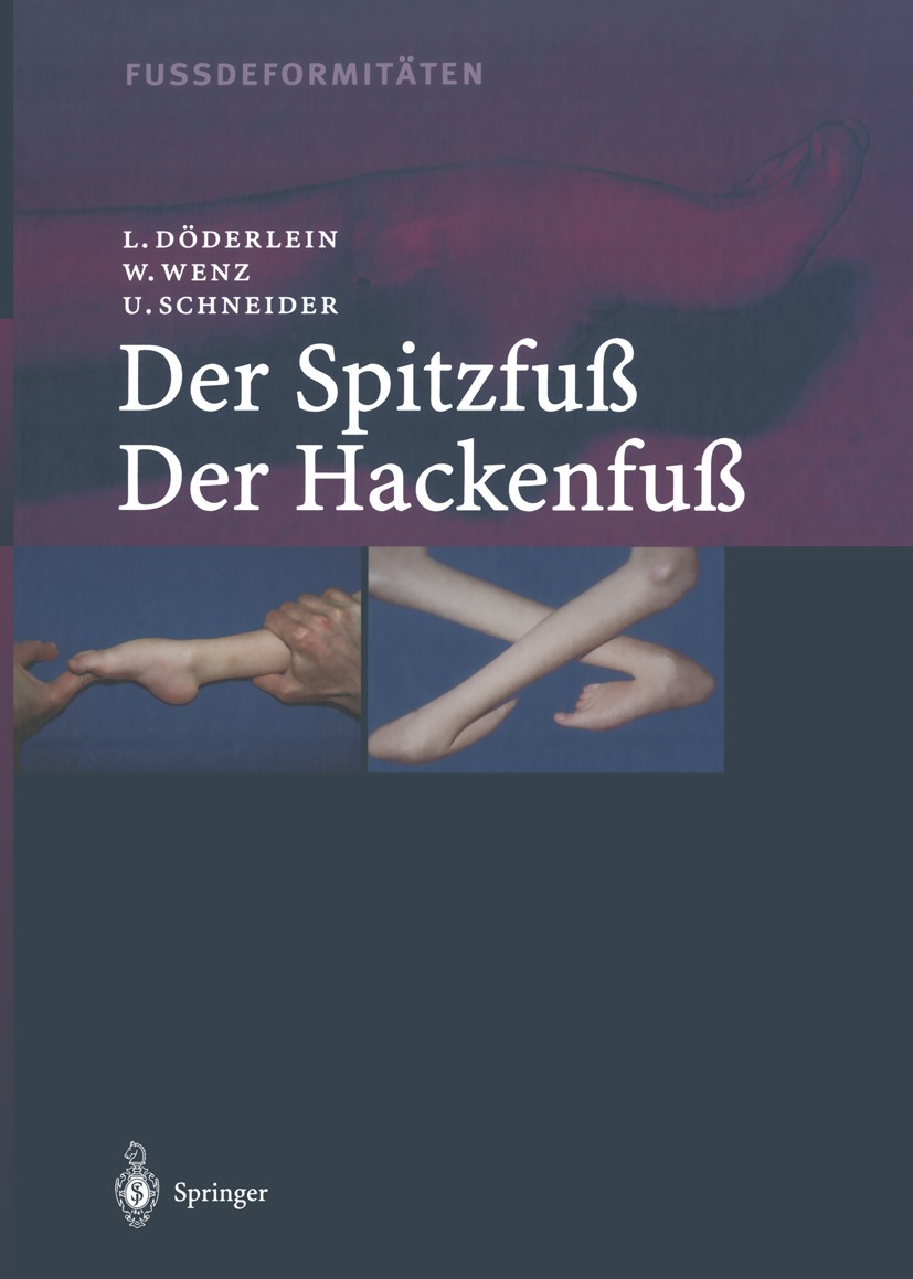 Titlebook: Fussdeformitäten; Der Spitzfuss/Der Ha Leonhard Döderlein,Wolfram Wenz,Urs Schneider Book 2004 Springer-Verlag Berlin Heidelberg 2004 Fußde Titlebook: Fussdeformitäten; Der Spitzfuss/Der Ha Leonhard Döderlein,Wolfram Wenz,Urs Schneider Book 2004 Springer-Verlag Berlin Heidelberg 2004 Fußde