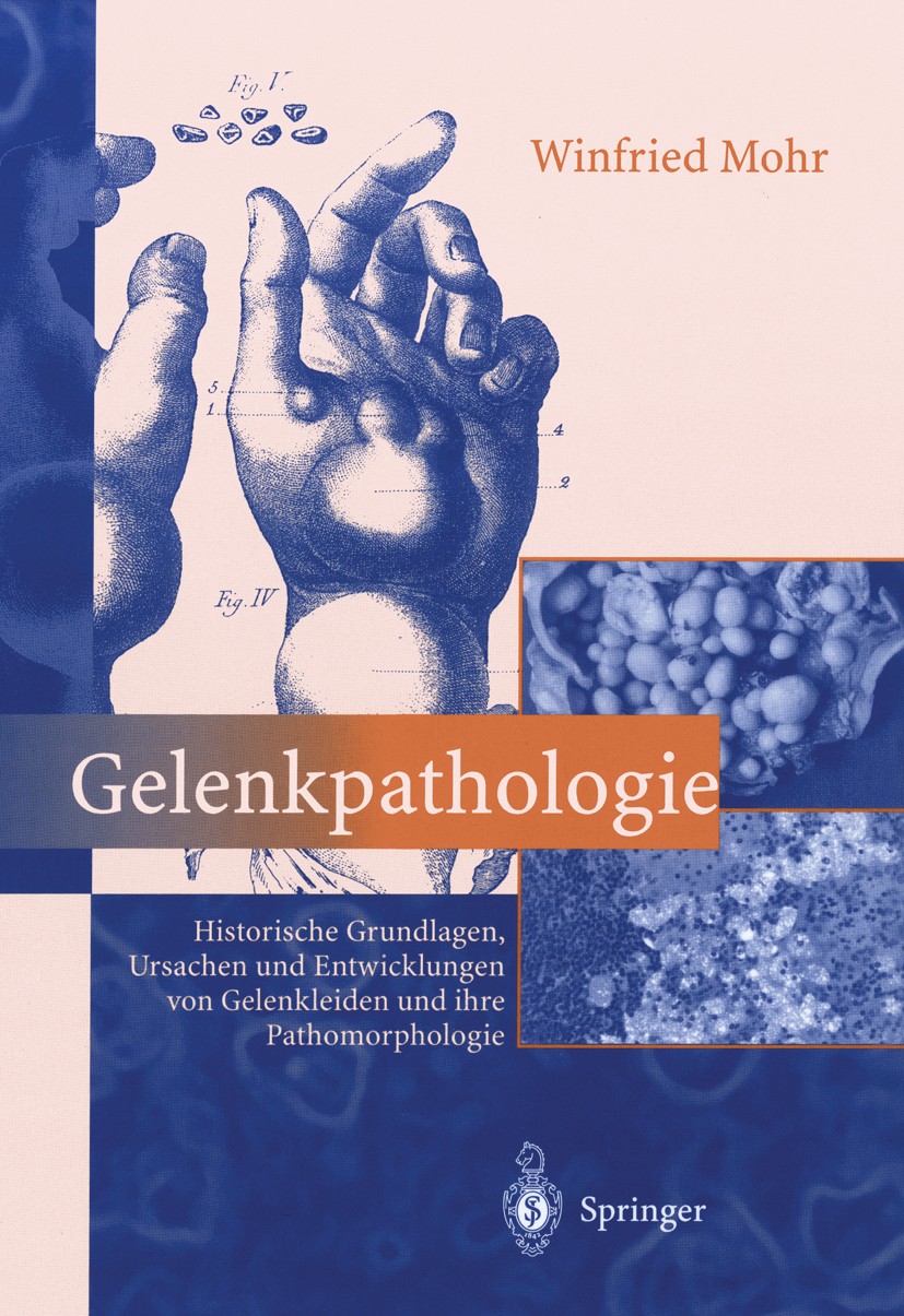 Titlebook: Gelenkpathologie; Historische Grundlag Winfried Mohr Book 2000 Springer-Verlag Berlin Heidelberg 2000 Arthritis.Arthropathie.Arthrose.Beweg Titlebook: Gelenkpathologie; Historische Grundlag Winfried Mohr Book 2000 Springer-Verlag Berlin Heidelberg 2000 Arthritis.Arthropathie.Arthrose.Beweg