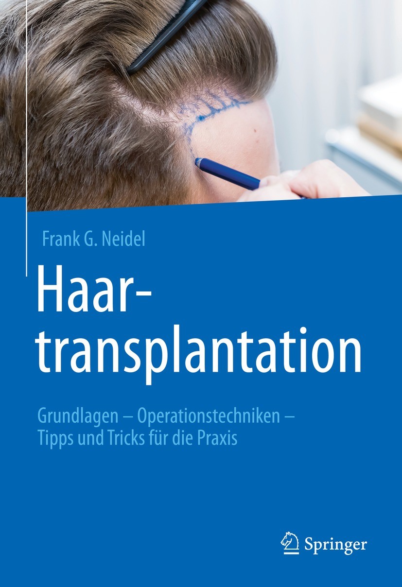Titlebook: Haartransplantation; Grundlagen – Operati Frank G. Neidel Book 2022 Springer-Verlag GmbH Deutschland, ein Teil von Springer Nature 2022 Haa Titlebook: Haartransplantation; Grundlagen – Operati Frank G. Neidel Book 2022 Springer-Verlag GmbH Deutschland, ein Teil von Springer Nature 2022 Haa