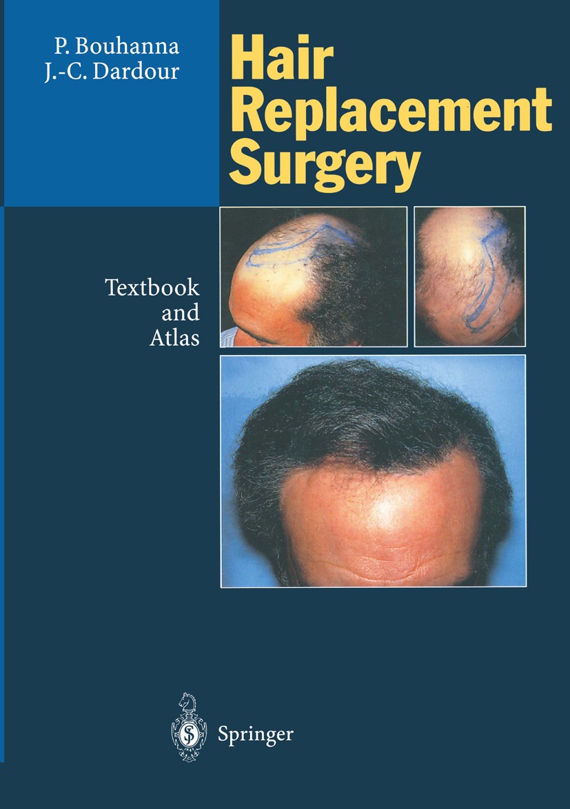 Titlebook: Hair Replacement Surgery; Textbook and Atlas Pierre Bouhanna,Jean-Claude Dardour Book 1996 Springer-Verlag Berlin Heidelberg 1996 Dermatiti Titlebook: Hair Replacement Surgery; Textbook and Atlas Pierre Bouhanna,Jean-Claude Dardour Book 1996 Springer-Verlag Berlin Heidelberg 1996 Dermatiti