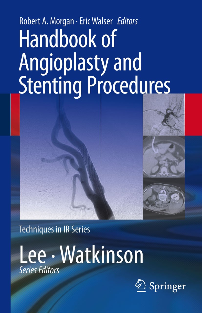 Titlebook: Handbook of Angioplasty and Stenting Procedures; Robert A. Morgan,Eric Walser Book 2010 Springer-Verlag London 2010 Ablation.Stent.aneurys Titlebook: Handbook of Angioplasty and Stenting Procedures; Robert A. Morgan,Eric Walser Book 2010 Springer-Verlag London 2010 Ablation.Stent.aneurys