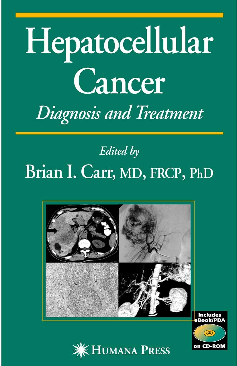 Titlebook: Hepatocellular Carcinoma; Diagnosis and Treatm Brian I. Carr Book 20051st edition Humana Press 2005 Cell Cycle Growth Inhibitors.HCC Tumor Titlebook: Hepatocellular Carcinoma; Diagnosis and Treatm Brian I. Carr Book 20051st edition Humana Press 2005 Cell Cycle Growth Inhibitors.HCC Tumor