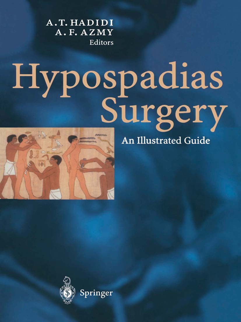 Titlebook: Hypospadias Surgery; An Illustrated Guide Ahmed T. Hadidi,Amir F. Azmy Book 2004 Springer-Verlag Berlin Heidelberg 2004 Congenital.Penis.Re Titlebook: Hypospadias Surgery; An Illustrated Guide Ahmed T. Hadidi,Amir F. Azmy Book 2004 Springer-Verlag Berlin Heidelberg 2004 Congenital.Penis.Re