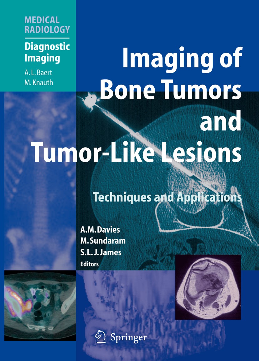 Titlebook: Imaging of Bone Tumors and Tumor-Like Lesions; Techniques and Appli A. Mark Davies,Murali Sundaram,Steven L. J. James Book 2009 Springer-Ve Titlebook: Imaging of Bone Tumors and Tumor-Like Lesions; Techniques and Appli A. Mark Davies,Murali Sundaram,Steven L. J. James Book 2009 Springer-Ve