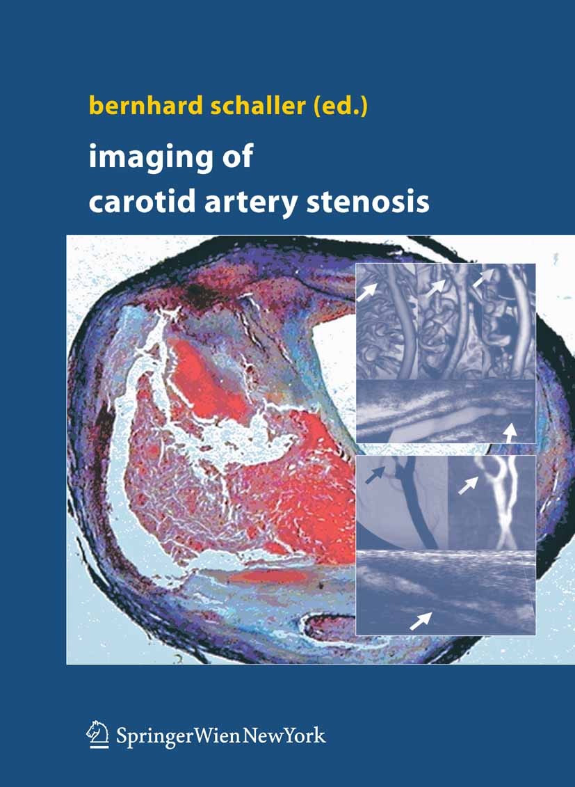 Titlebook: Imaging of Carotid Artery Stenosis; Bernhard J. Schaller Book 2007 Springer-Verlag Vienna 2007 Examination techniques.Non-surgical point o Titlebook: Imaging of Carotid Artery Stenosis; Bernhard J. Schaller Book 2007 Springer-Verlag Vienna 2007 Examination techniques.Non-surgical point o