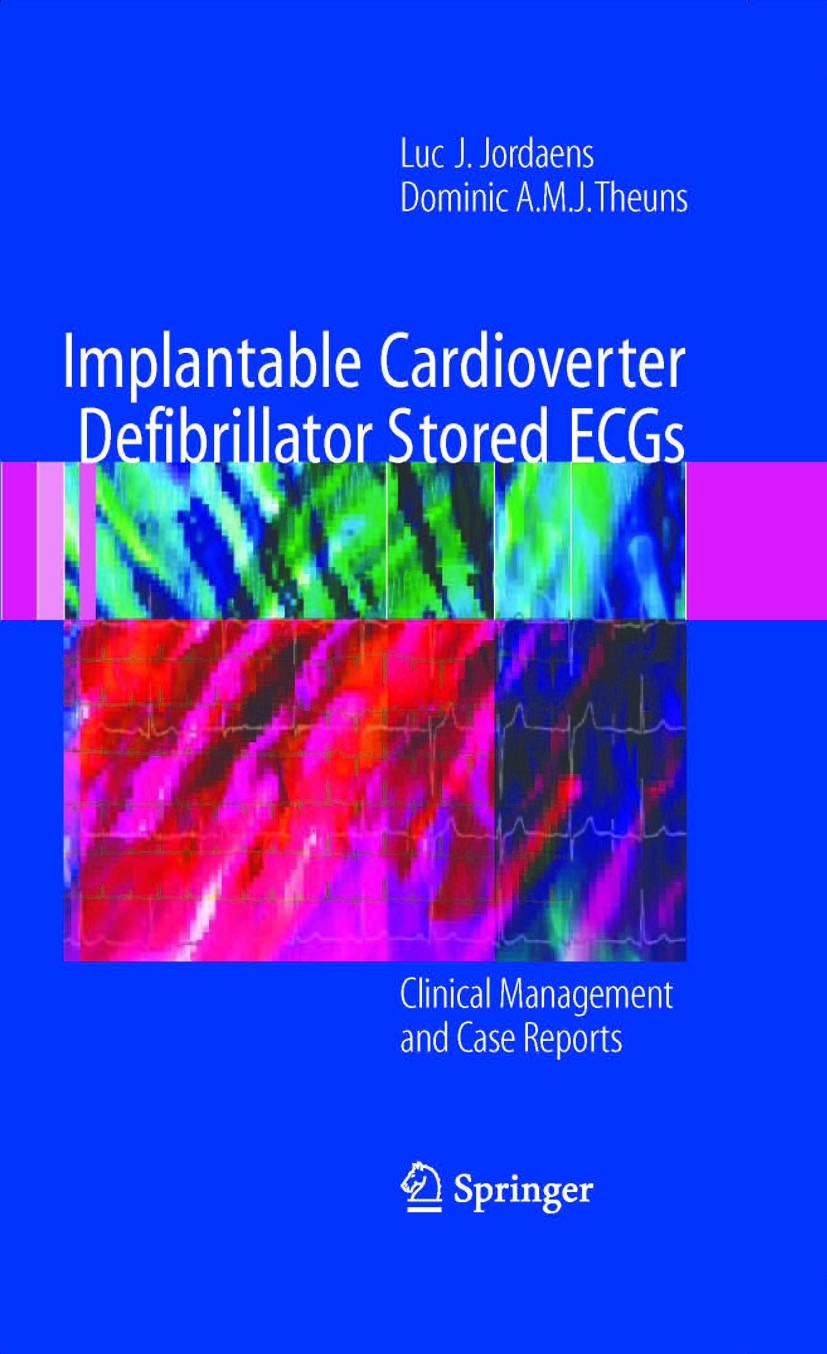 Titlebook: Implantable Cardioverter Defibrillator Stored ECGs; Clinical Management Luc J. Jordaens,Dominic A.M.J. Theuns Book 2007 Springer-Verlag Lo Titlebook: Implantable Cardioverter Defibrillator Stored ECGs; Clinical Management Luc J. Jordaens,Dominic A.M.J. Theuns Book 2007 Springer-Verlag Lo
