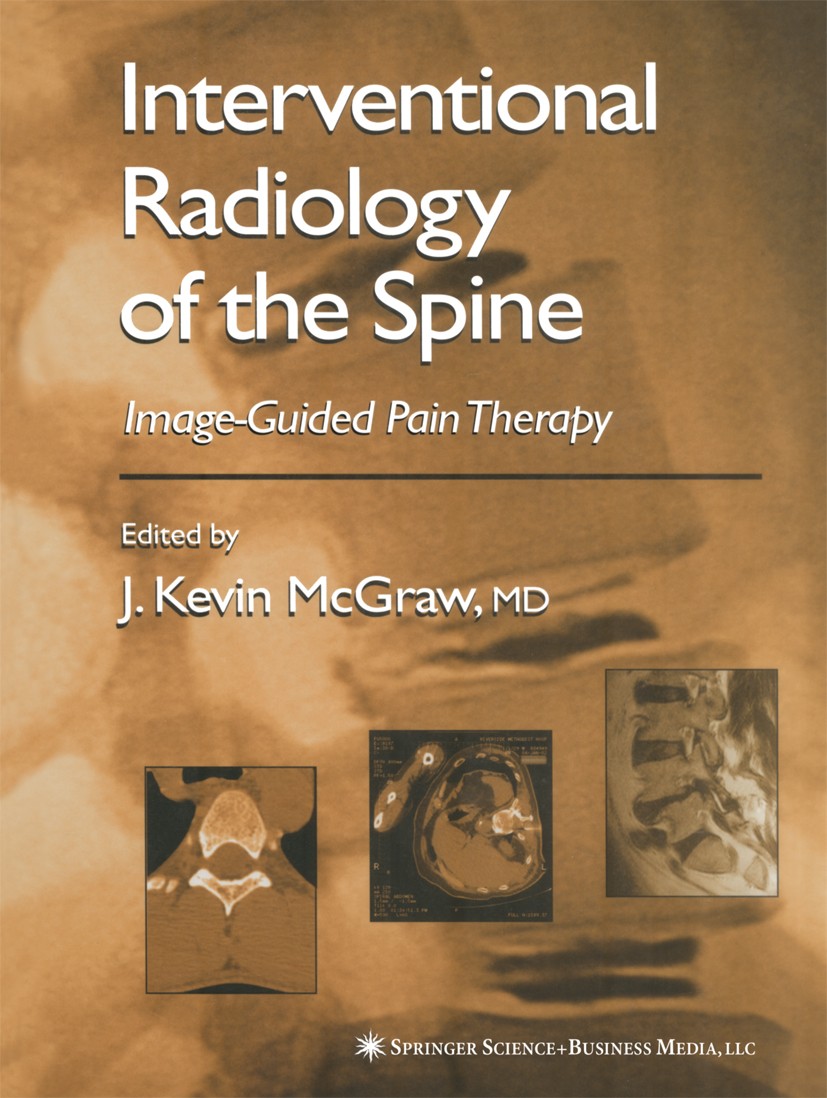 Titlebook: Interventional Radiology of the Spine; Image-Guided Pain Th J. Kevin McGraw Book 2004 Humana Press 2004 Tumor.computed tomography (CT).inte Titlebook: Interventional Radiology of the Spine; Image-Guided Pain Th J. Kevin McGraw Book 2004 Humana Press 2004 Tumor.computed tomography (CT).inte