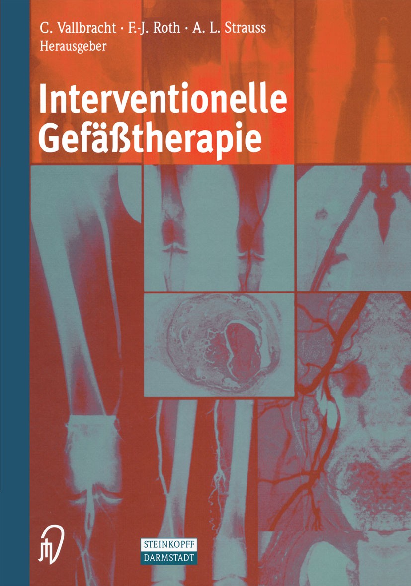 Titlebook: Interventionelle Gefäßtherapie; Christian Vallbracht,Franz-Josef Roth,Andreas L. S Book 2002 Springer-Verlag Berlin Heidelberg 2002 Angiol Titlebook: Interventionelle Gefäßtherapie; Christian Vallbracht,Franz-Josef Roth,Andreas L. S Book 2002 Springer-Verlag Berlin Heidelberg 2002 Angiol