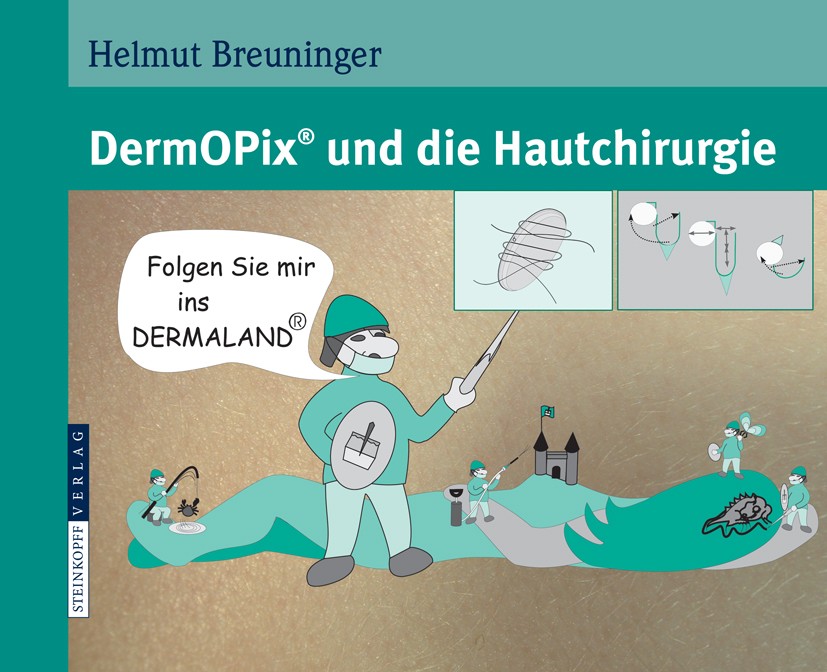Titlebook: DermOPix® und die Hautchirurgie; Helmut Breuninger Book 20081st edition Der/die Herausgeber bzw. der/die Autor(en), exklusiv lizenziert an Titlebook: DermOPix® und die Hautchirurgie; Helmut Breuninger Book 20081st edition Der/die Herausgeber bzw. der/die Autor(en), exklusiv lizenziert an